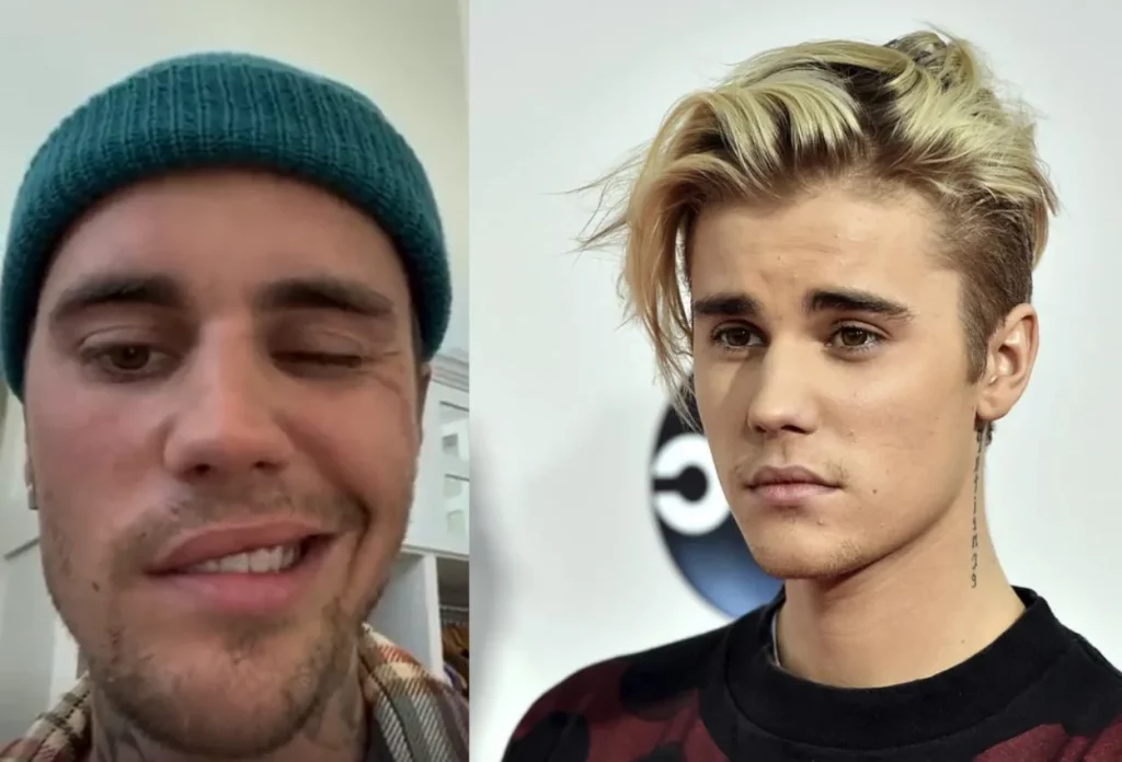 Justin Bieber Paralyzed half his face