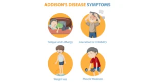 Addison’s disease is a chronic condition where a person’s adrenal glands do not produce enough of the hormones cortisol and aldosterone